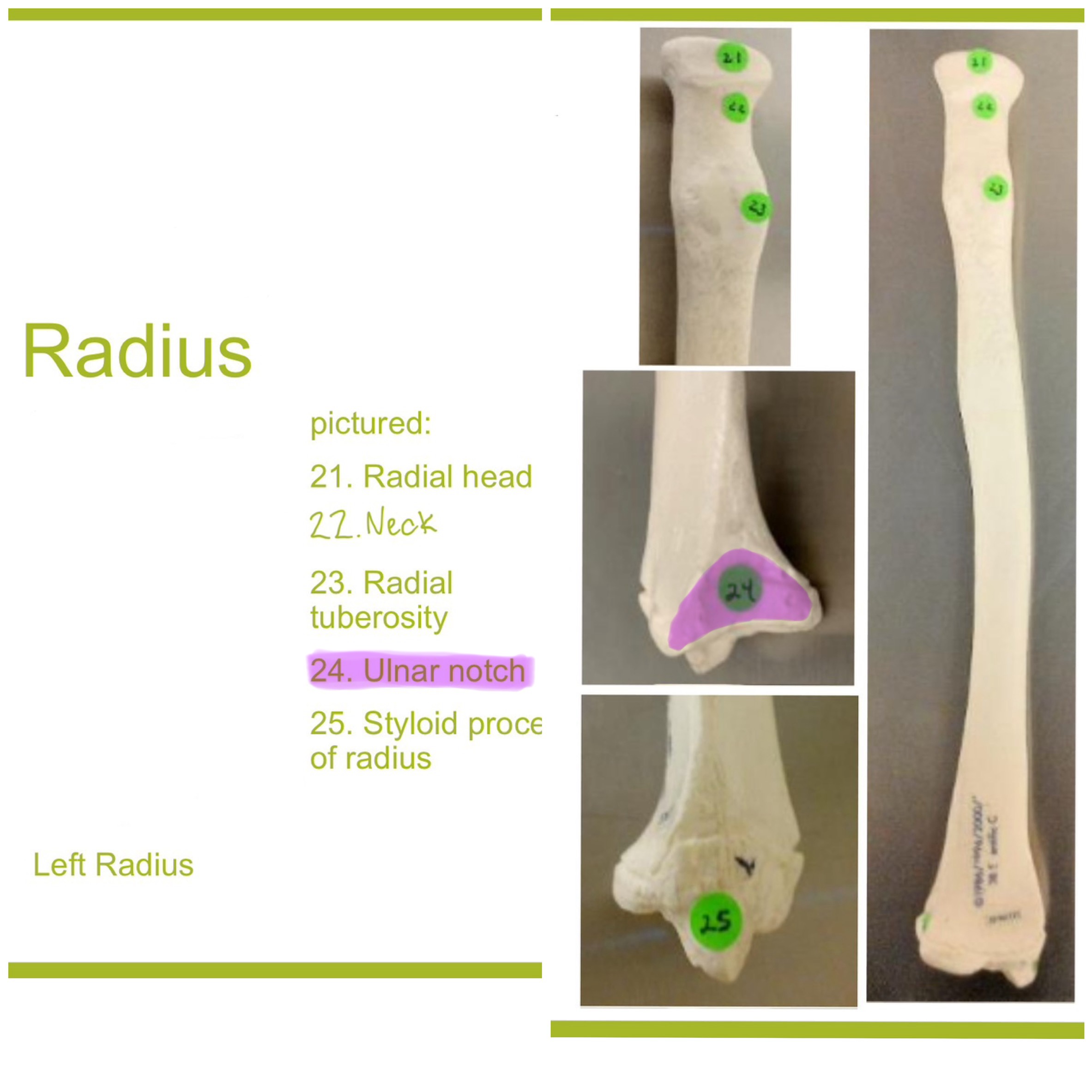 <p>ulnar notch of radius</p>