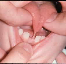 <p>What is Ankyloglossia commonly called, and what causes it?</p>
