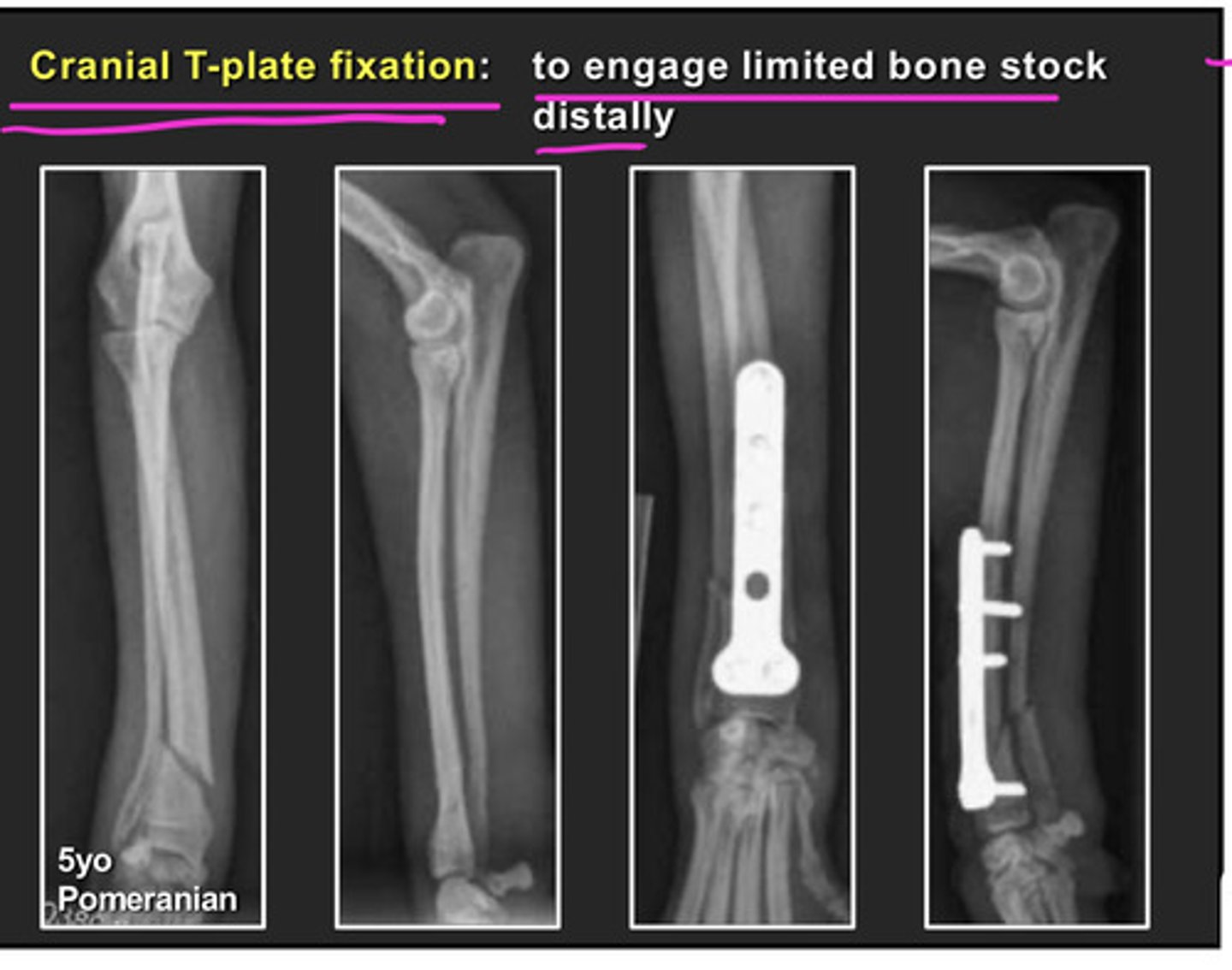 <p>-reconstruction of comminuted fractures</p>