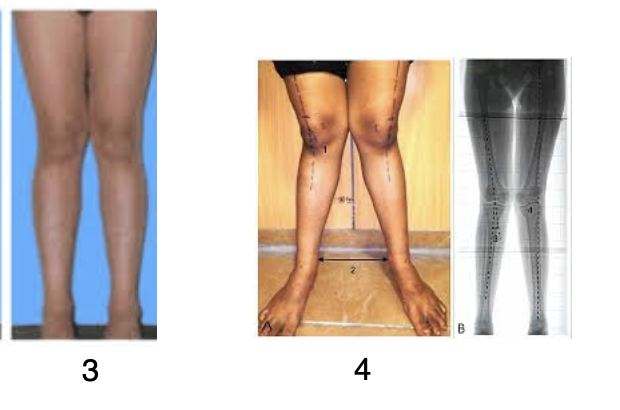 <p><span>Which angular deformity does this patient have?</span></p><p></p>