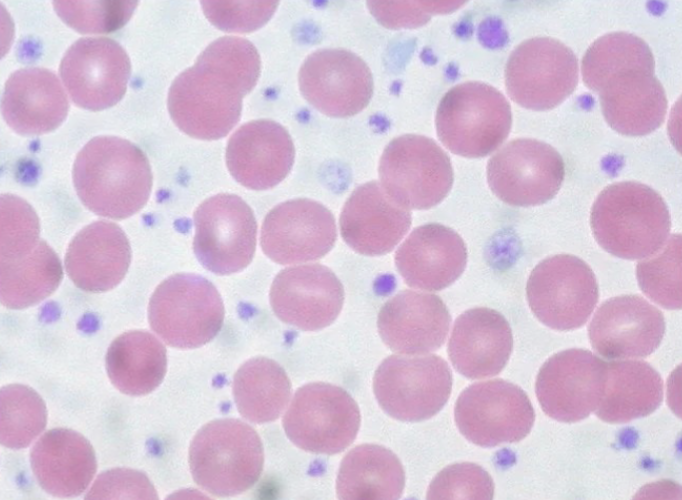 <ul><li><p>Platelet count &gt;1-2 million</p><ul><li><p> Platelets are clumped, bizarre shape and size</p></li><li><p> Function may be abnormal</p></li><li><p> Usually secondary to another disorder</p></li></ul></li></ul><p></p>