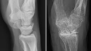 <p>generalized or localized deficiency of bone matrix in which the mass of bone per unit volume is decreased in amount butnormal in composition. Causes include aging and postmenopausal hormonal changes. A decrease in kvp is required to obtain quality image.</p>