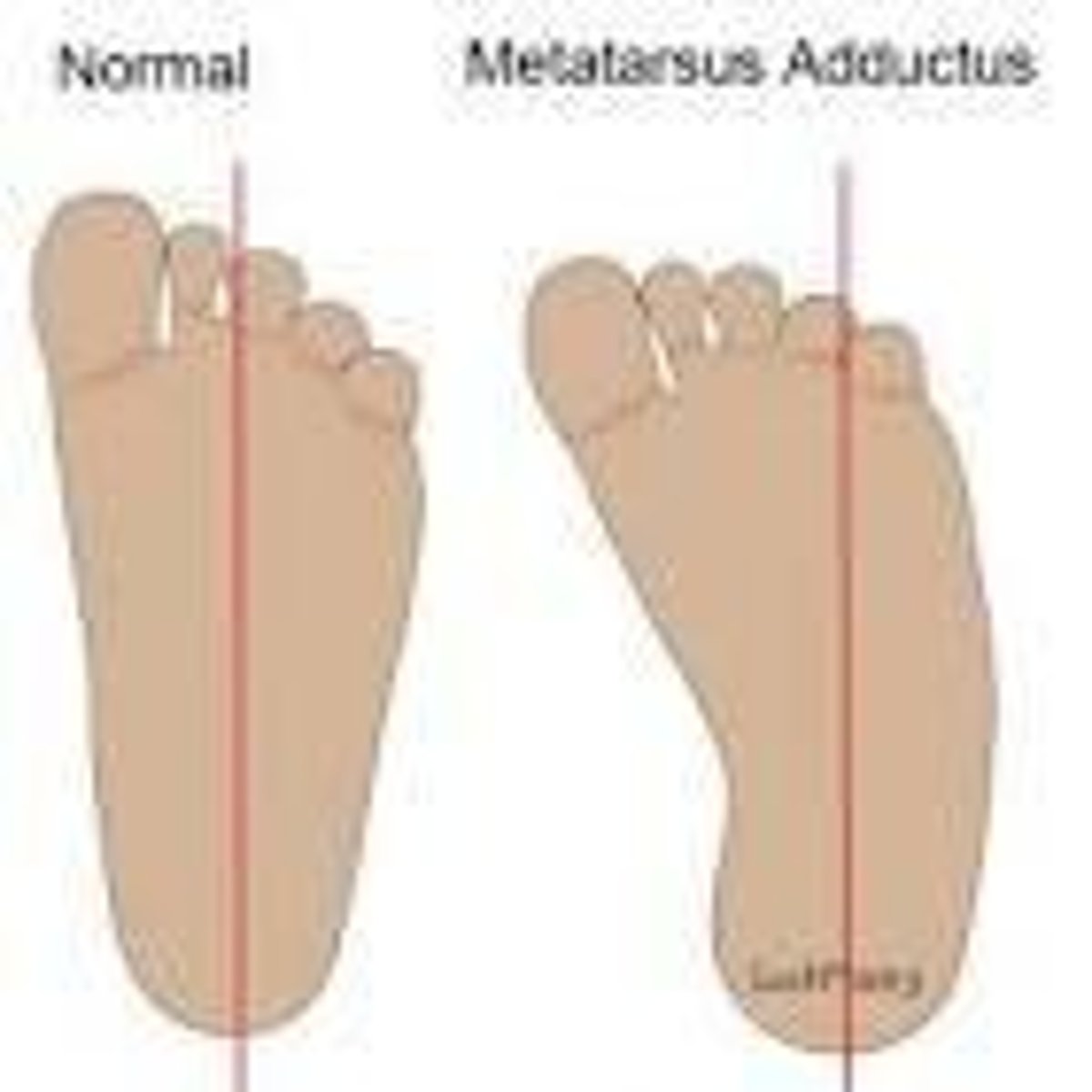 <p>Metatarsus adductus is flexible and corrects past midline, while clubfoot is rigid.</p>