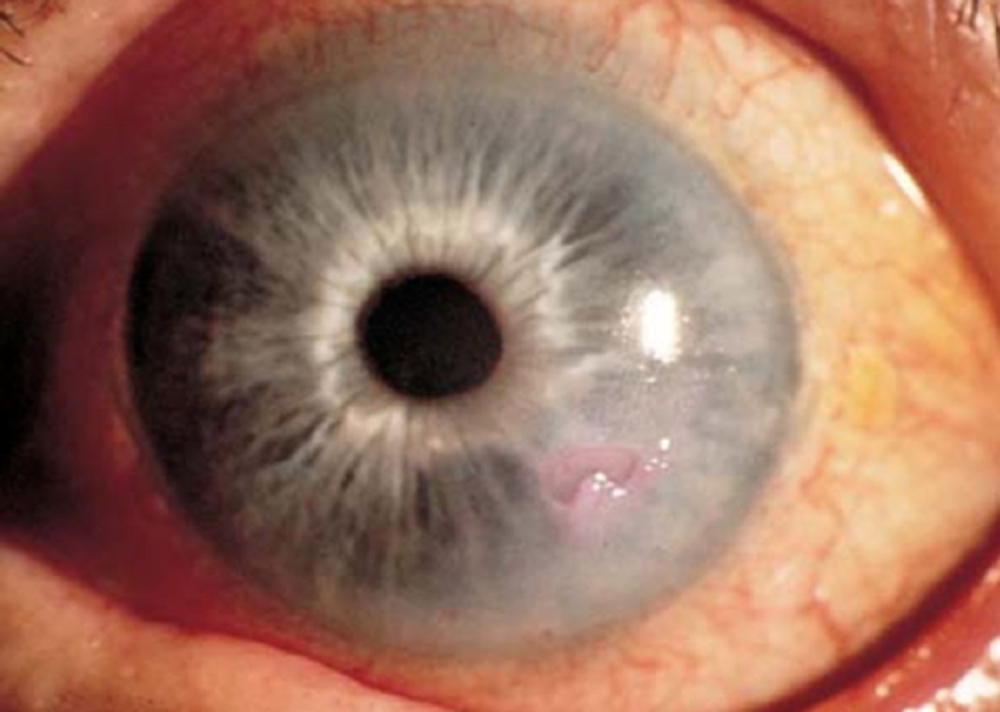 <p>disruption of the corneal epithelium and stroma</p>