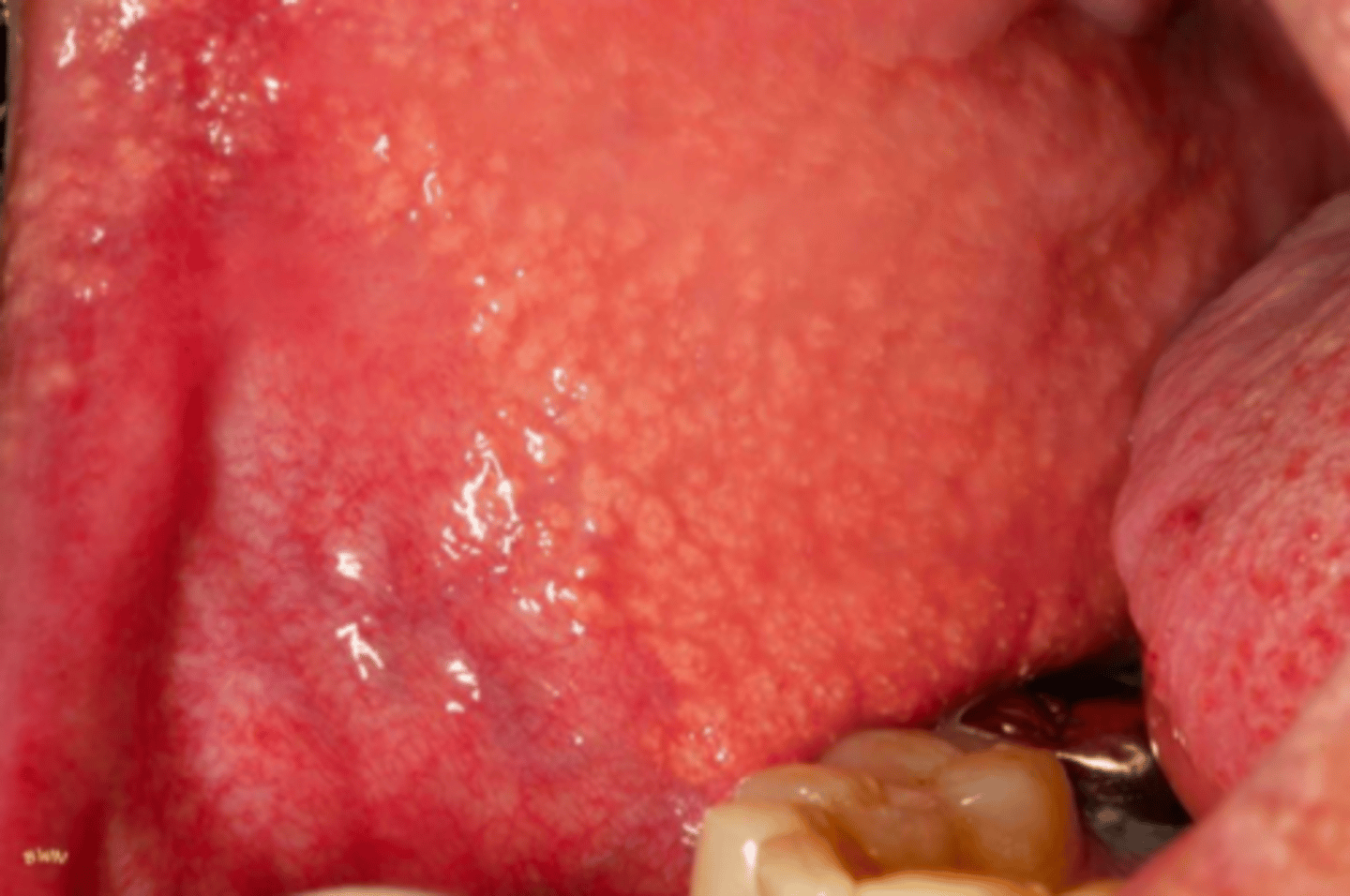 <p>multiple small papules</p><p>• common locations: vestibule, buccal mucosa</p>
