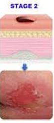 <p></p><p></p><p>Partial thickness skin loss, may present as a blister; pink, red, moist wound.</p>