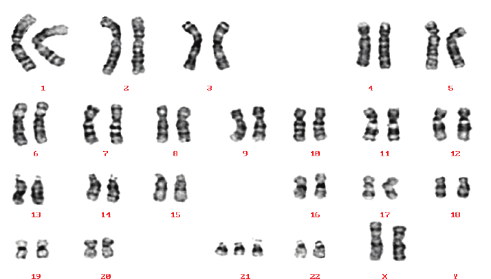 <p>Down syndrome</p><p>3 copies of chromosome 21</p><p>1 in 700 children born in U.S.</p><p>Chromosome 21 is the smallest human chromosome</p><p>but still severe effects</p><p>Frequency of Down syndrome correlates with the age of the mother</p><p></p>