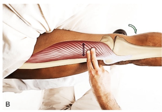 <p>vastus medialis</p>