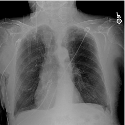 <ul><li><p>widened intercostal spaces</p></li><li><p>flattened hemidiaphragms</p></li><li><p>squared off costophrenic angles and rib angles that approach 90 degree angles </p></li></ul><p></p>