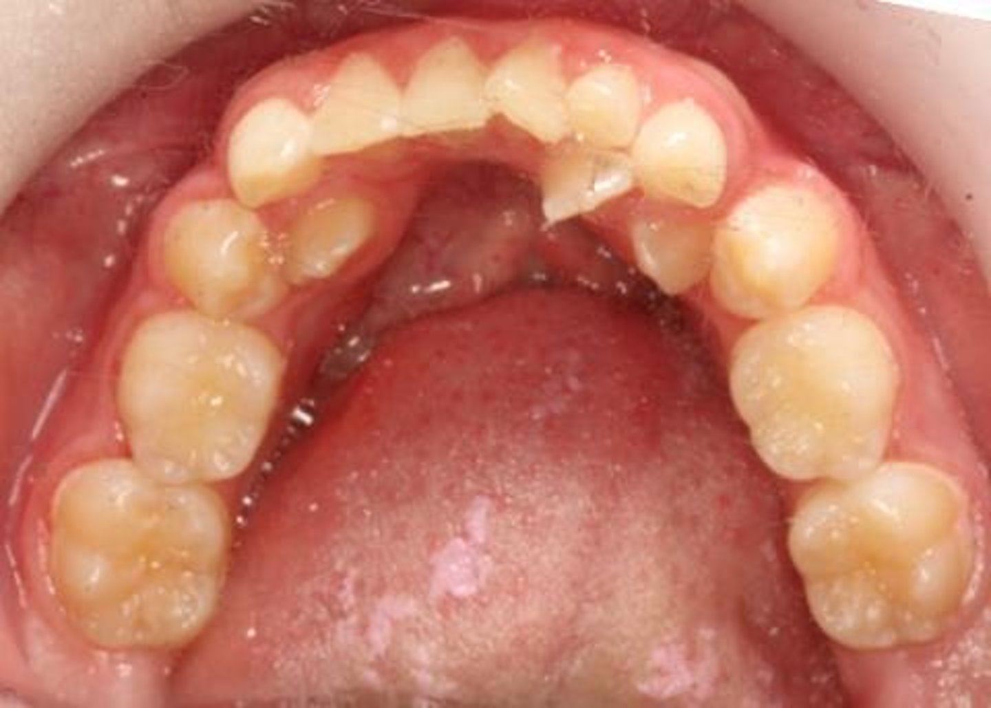 <p>Insufficient space for teeth in the jaw.</p>