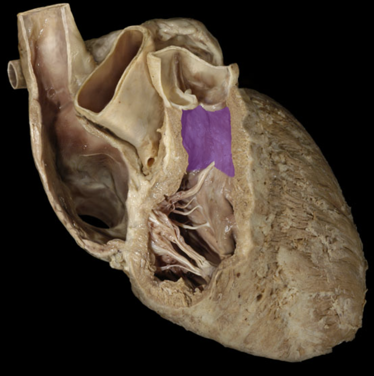 <p>Conus arteriosus</p>