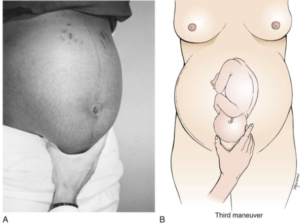 <ul><li><p>on fetal presenting part</p></li></ul><p></p>