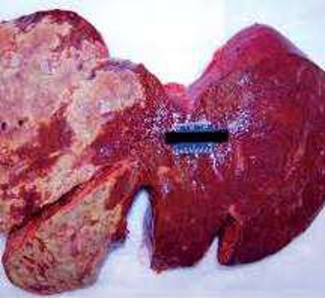 <p>High thyroid hormone levels are hepatotoxic and can cause mild to moderate ALT elevations.</p>