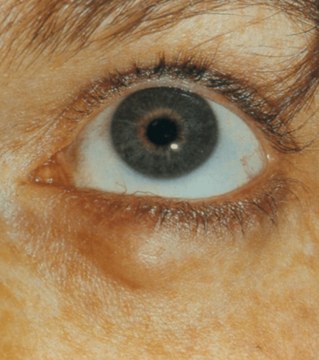 <p>What condition shown here must we consider with a hordeolum?</p>