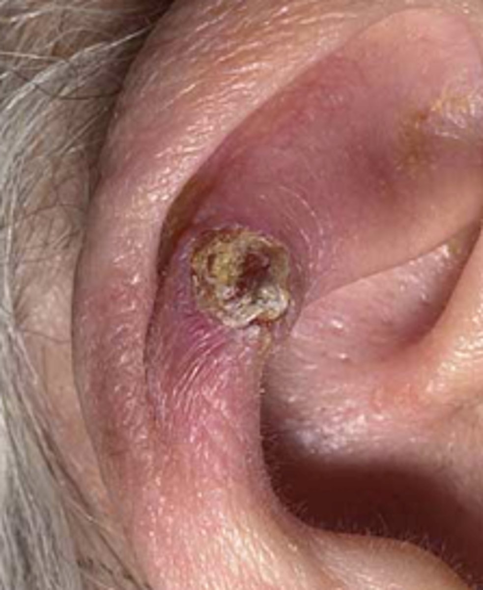 <p>Basal/Squamous cell carcinoma or malignant melanoma</p><p>Common in fair skin</p><p>Possible growth &amp; ulceration</p><p>NB - biopsy</p>