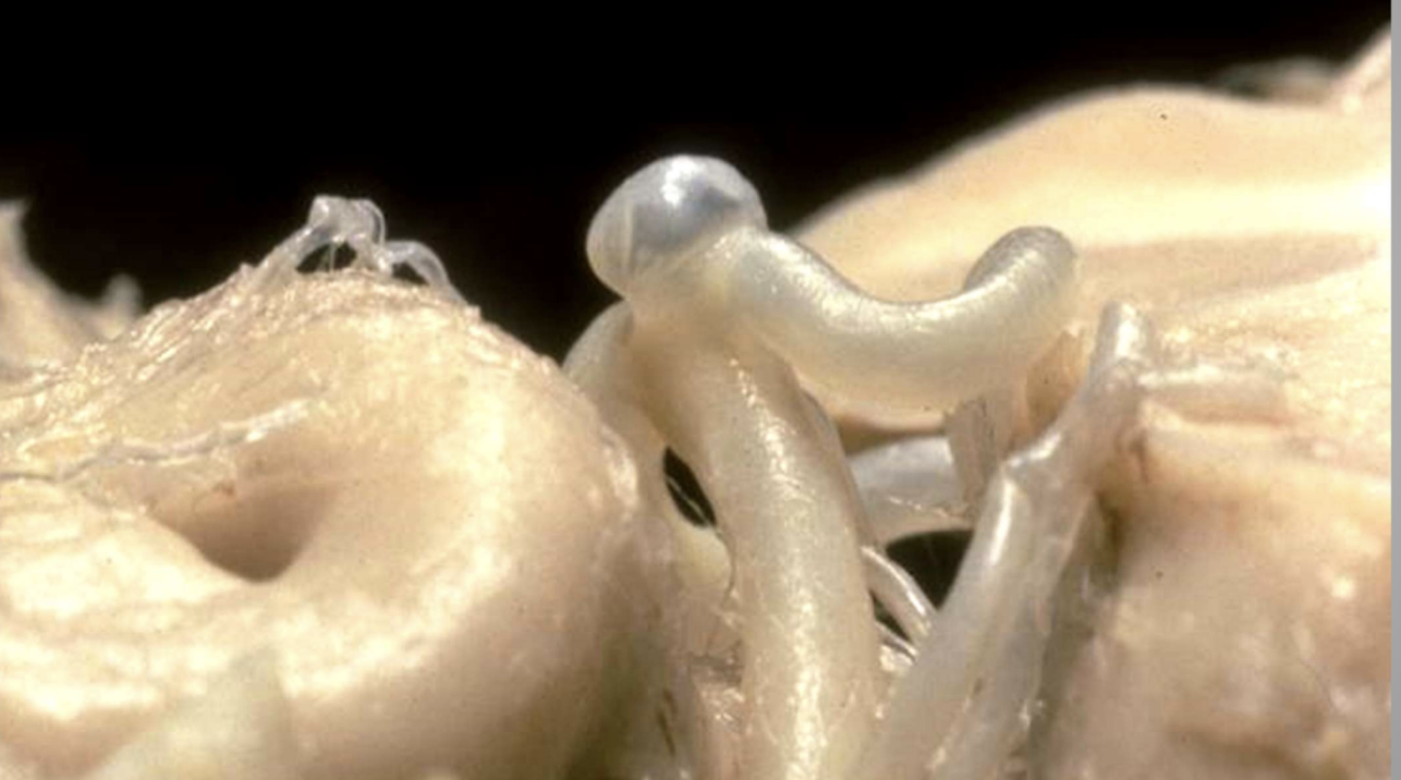 <p>Congenital</p>