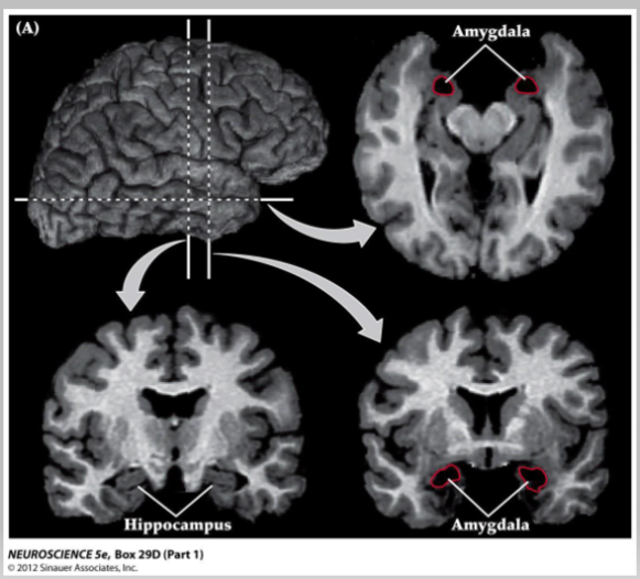 <p>The Amygdala and Fear: Patient SM</p><p></p><p><span style="color: rgb(251, 251, 251)">• Patient “S.M.”; Urbach-Wiethe disease, destroyed ____ bilaterally</span></p><p><span style="color: rgb(251, 251, 251)"><br></span>• <span style="color: rgb(251, 251, 251)">Physically unable to feel ___- will approach ____ and ____</span></p><p><span style="color: rgb(251, 251, 251)"><br>• Cannot recognize ___ in ___ expressions</span></p><p><span style="color: rgb(251, 251, 251)"><br>• Does not have a concept of ____ ___</span></p><p><span style="color: rgb(251, 251, 251)"><br>• Does have ___ response that does not depend on the ____</span></p><p><span style="color: rgb(251, 251, 251)"><br>• Can follow group ___ responses due to ___ and ___ responses in others</span></p><p><span style="color: rgb(251, 251, 251)"><br>• Has survived ___ abuse and had a ___ held to her throat</span></p>