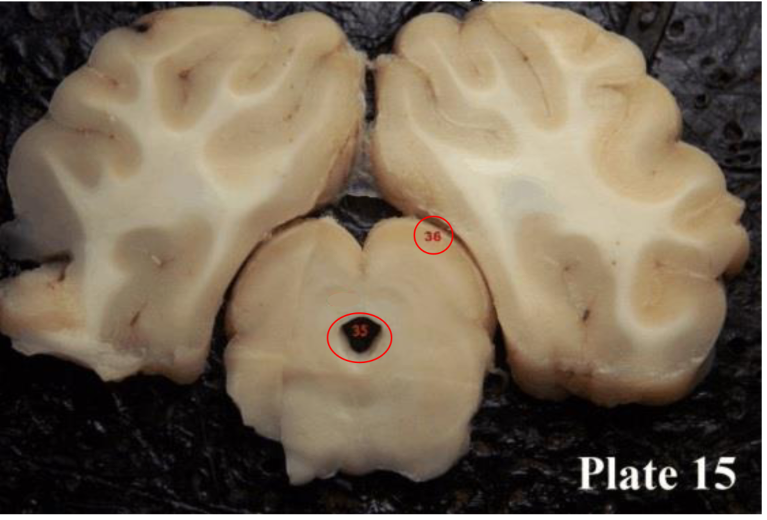 <p>(36) paired with the inferior colliculi to form the tectum or corpora quadregema </p>