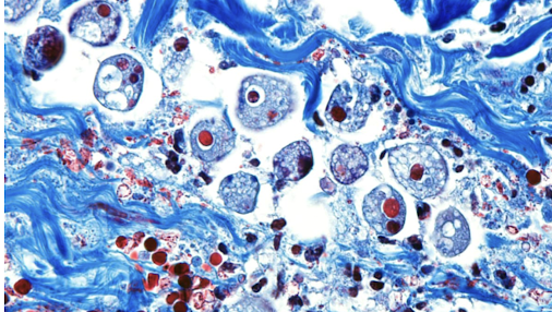 <p>Which intestinal protozoa is transmitted via <strong>ingestion of food or water containing contaminated cysts </strong>and causes:</p><ul><li><p><strong>amebiasis (diarrhea)</strong></p></li><li><p><strong>amebic dysentery (bloody diarrhea and fever)</strong></p><ul><li><p>common in tropical areas with poor sanitary conditions</p></li><li><p>rarely can disseminate to liver (forms abscess), lungs/brain</p></li></ul></li></ul>