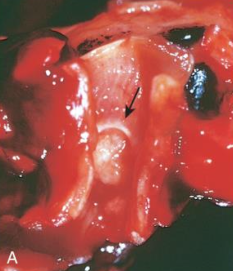 <p>Características de tumores carcinoides <strong>centrales</strong></p><p></p><p></p>