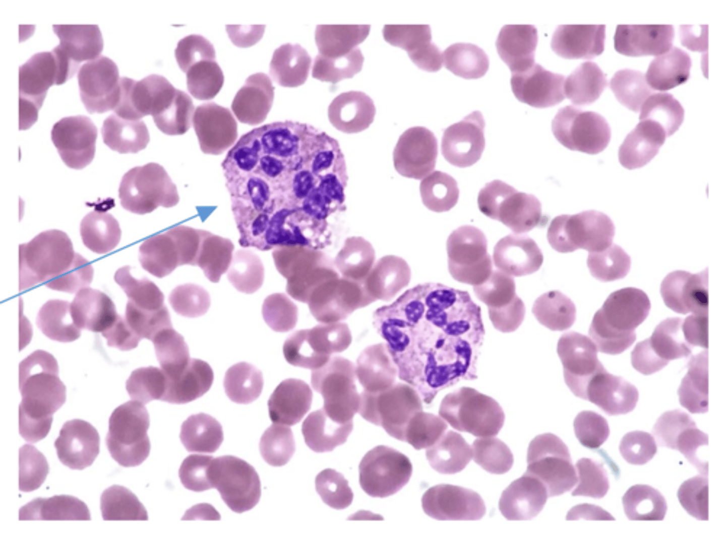 <p>B9/B12 anemia</p>