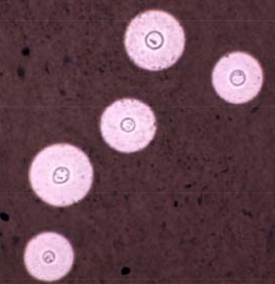 <p>Fungal respiratory infections.</p>