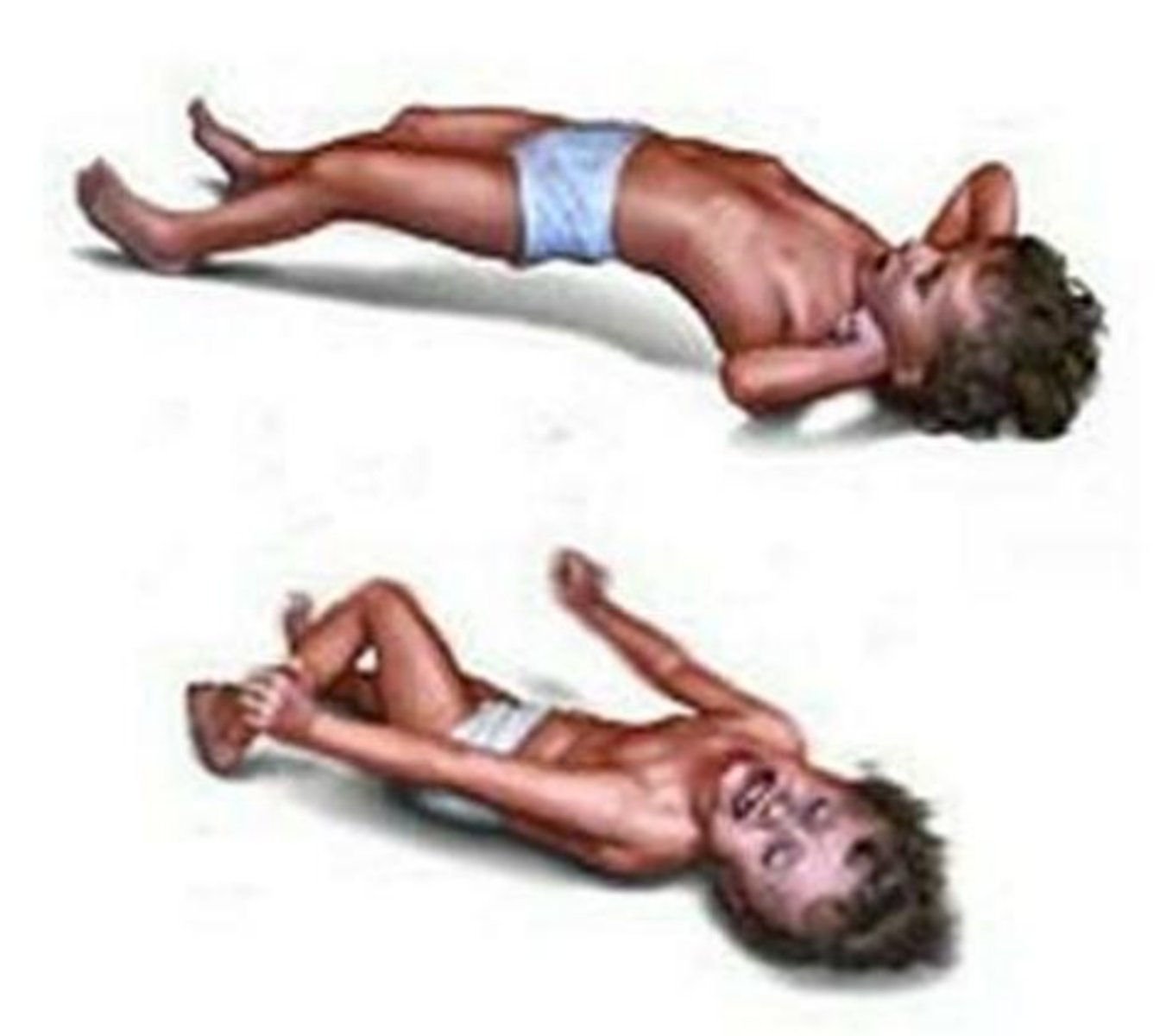 <p>- sudden uncontrolled muscle jerking</p><p>- can occur in clusters</p><p>- frequent falls</p>