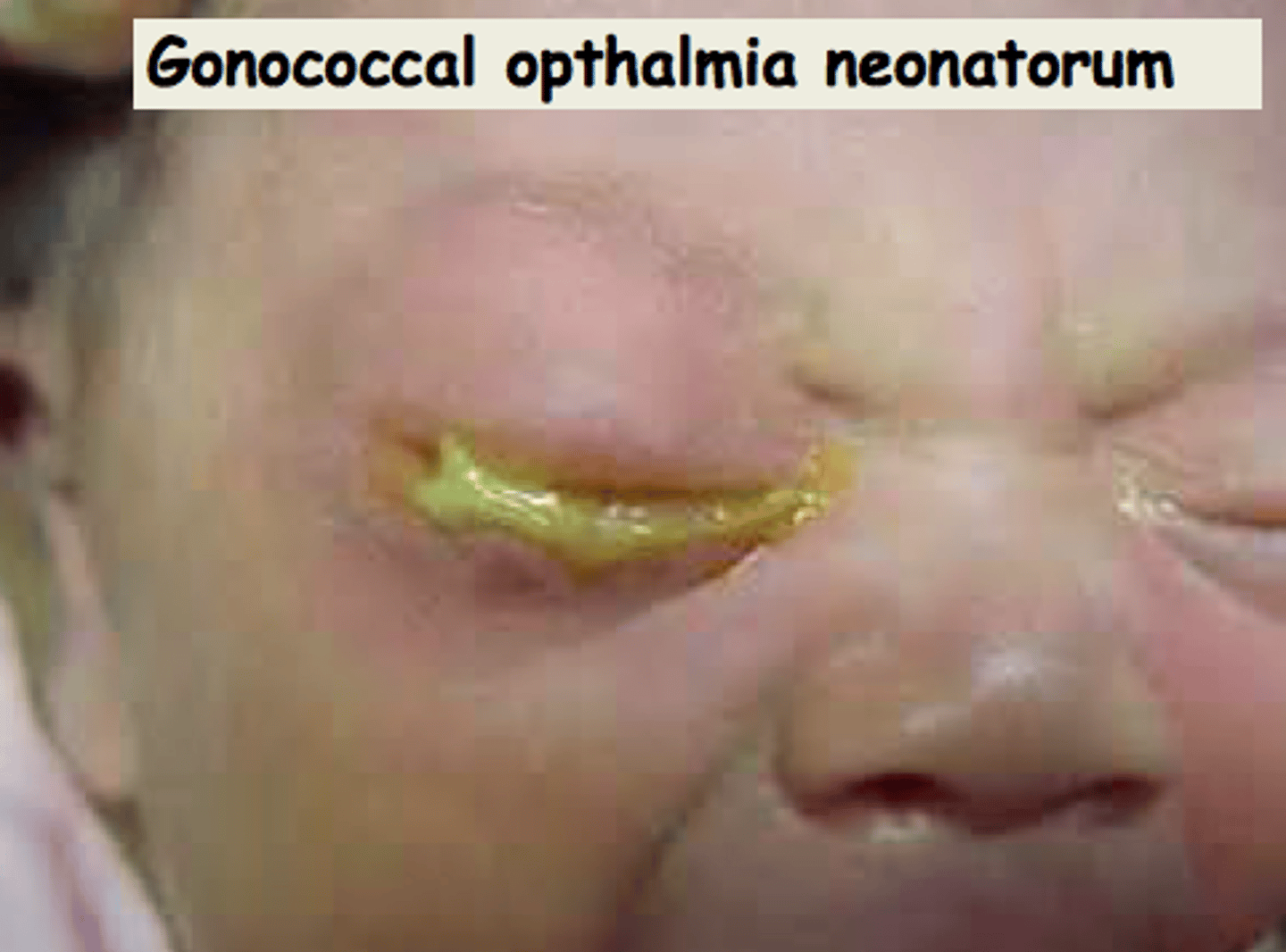 <p>purulent conjunctivitis, if untreated -> severe keratitis</p>