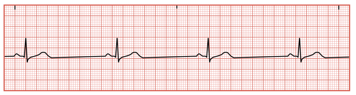 <p>Occurs when SA node sends an electrical impulse slower than 60bom&nbsp;</p>