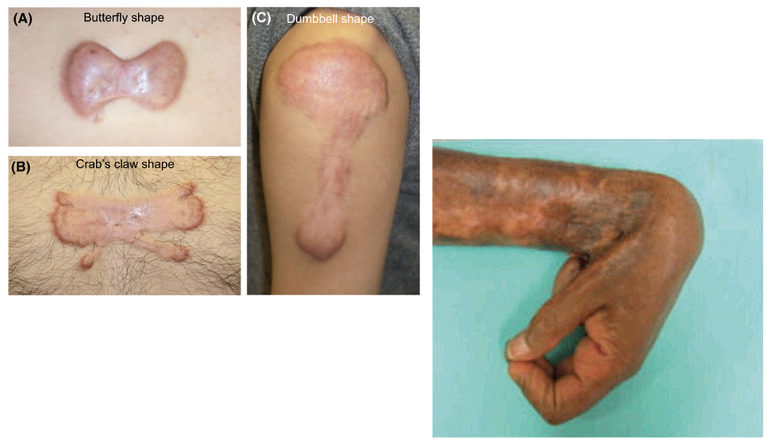 <p>Pathological aspects of wound healing:</p><p>What does this example depict?</p>