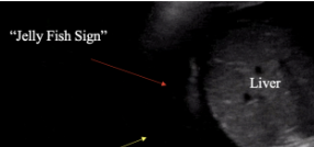 <p>What is the Jellyfish Sign?</p>