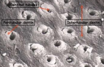 <p>Peritubulärt dentin: hög mineraliserad vägg som omger själva kanalen. </p><p>intertubulärt dentin: låg minderaliserad vägg som finns mellan kanalerna. den utgör största delen av dentinet och består av hydroxylapatit och kollagen. </p>