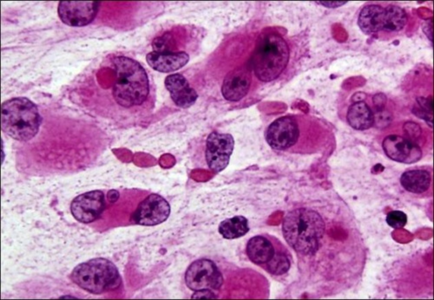 <p>Has sarcomatoid or rhabdoid appearance </p><p>(Rod-shaped) </p>