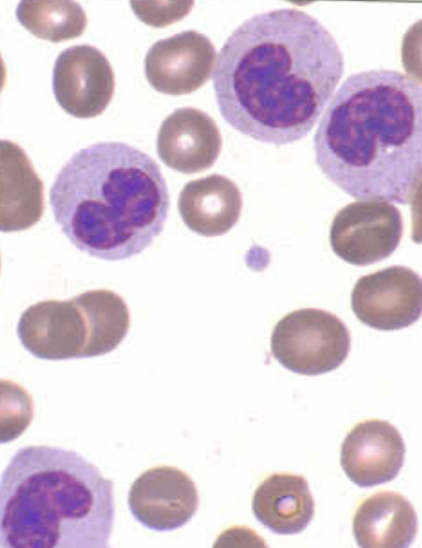 <p>(Pelger Huet/Pseudo Pelger Huet) anomaly is clinically significant with <strong>impaired </strong>bi-lobed <strong>hypogranular </strong>neutrophils.</p>