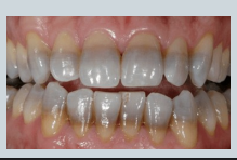 <p>abnormal colour of teeth - what causes <strong>banding</strong>?</p>