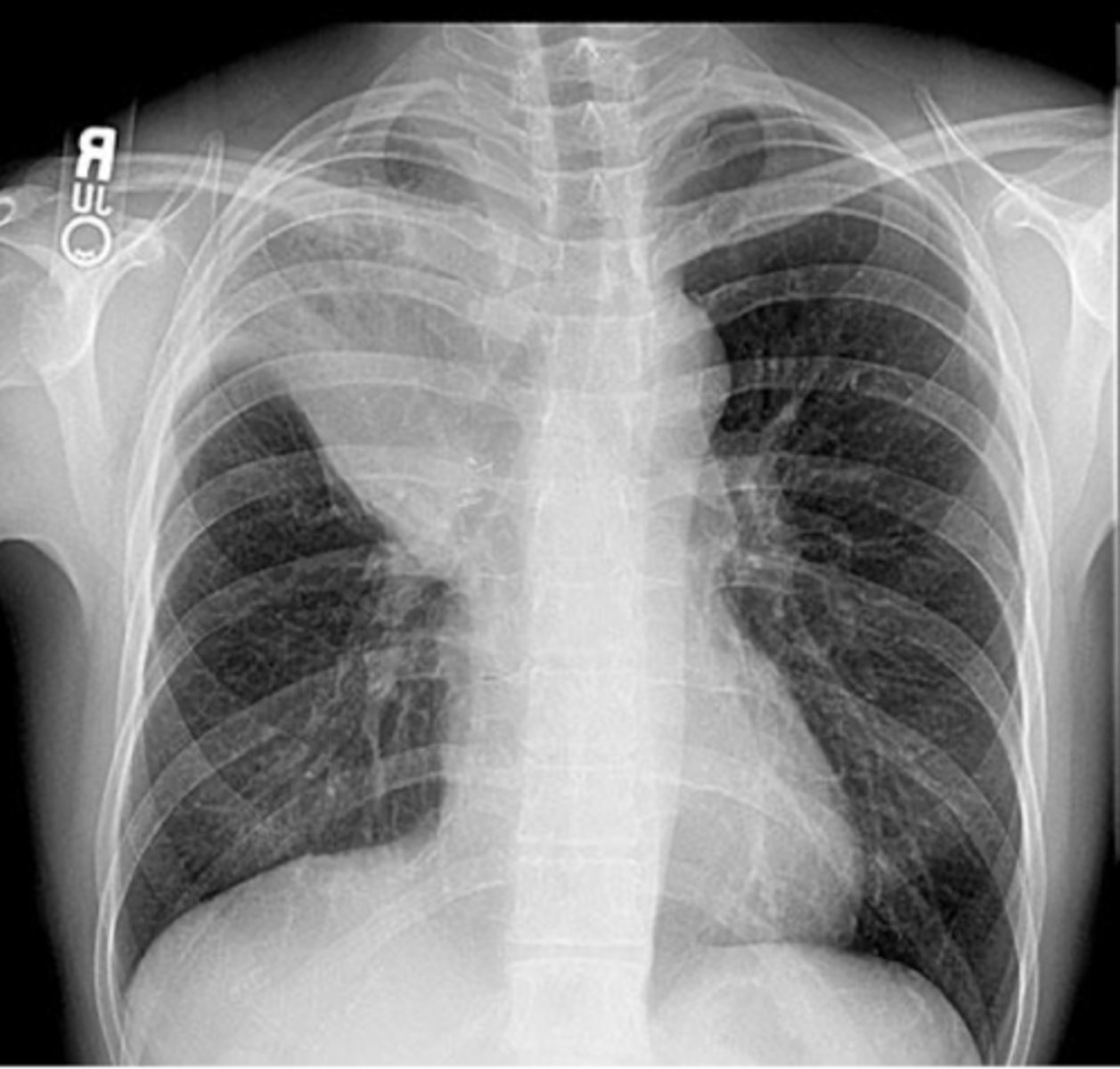 <p>What is the diagnosis? What sign is present?</p>