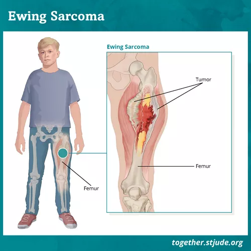 <p>Ewings Sarcoma</p><p>(that is why we can treat with RTT)</p>