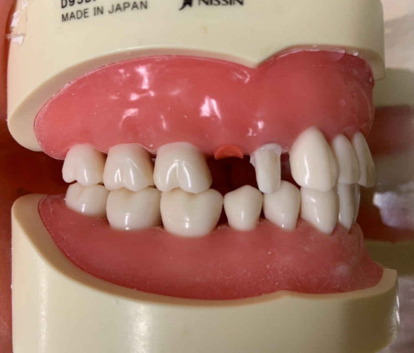 <p>What is wrong with the tooth prep on #5?</p>
