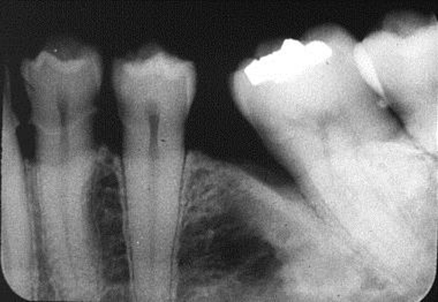 <p>Usually caused by the plate not being pushed into the lingual vestibule, or positioned on top of the tongue</p>