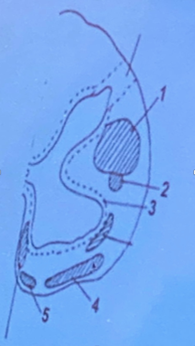 <p>Rubrospinal tract</p><p>Fasciculus proprius</p><p>Corticospinal tract</p><p>Inferior cerebellar peduncle</p>