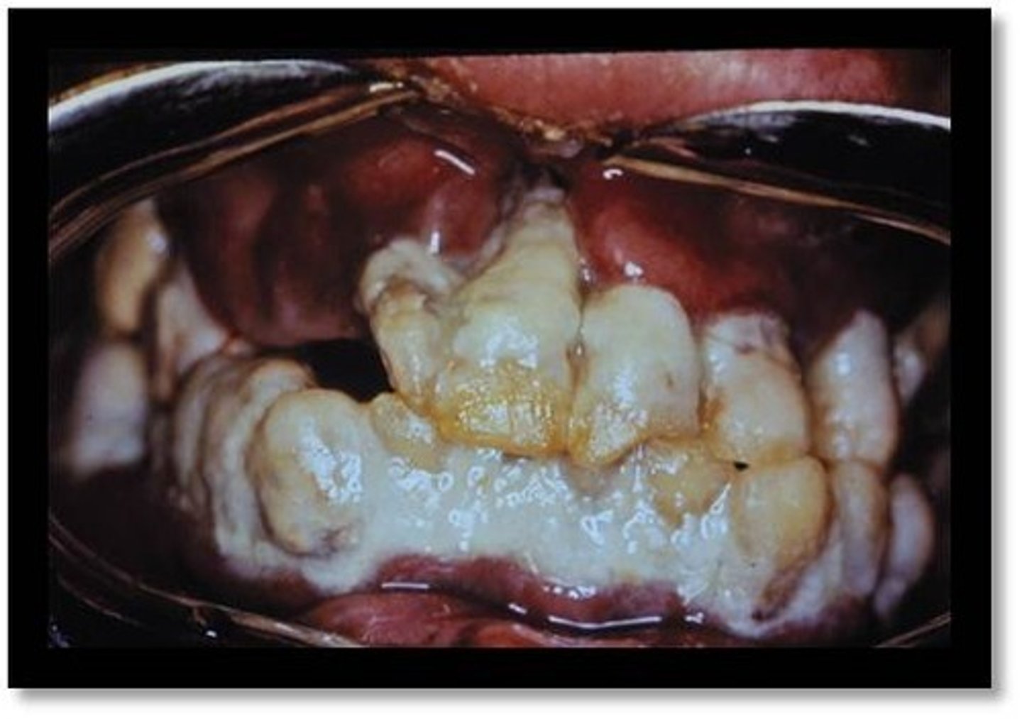 <p>A soft non-mineralized whitish deposit found on the tooth surface around the gingival margins, usually associated with poor oral hygiene</p>