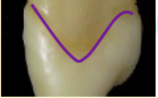 <p><mark data-color="green" style="background-color: green; color: inherit">maxillary canines #6 and #11; height of contour; lingual</mark></p>