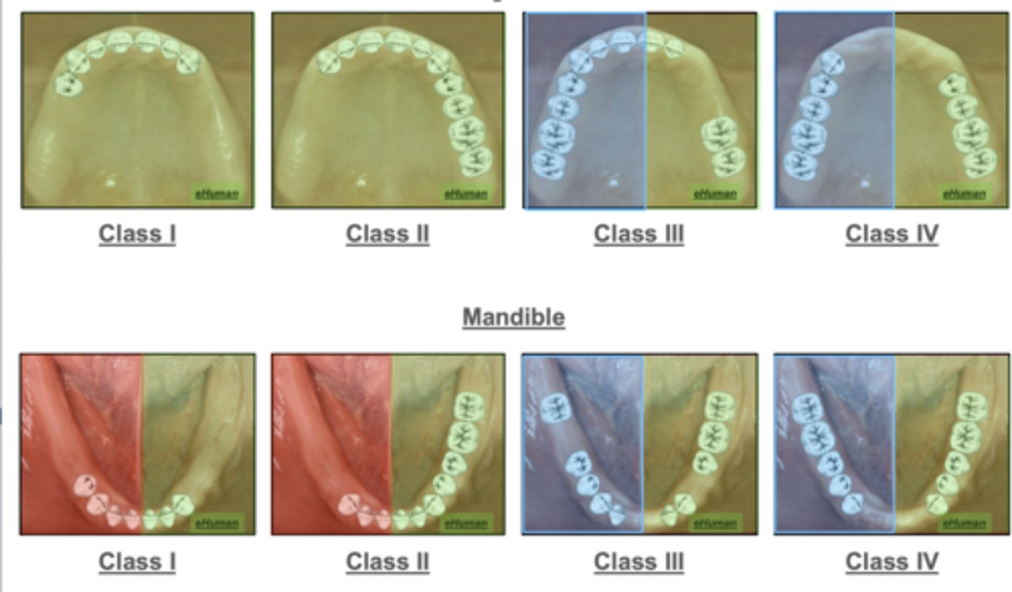 <p>What final impression technique is used for the red colored images?</p>