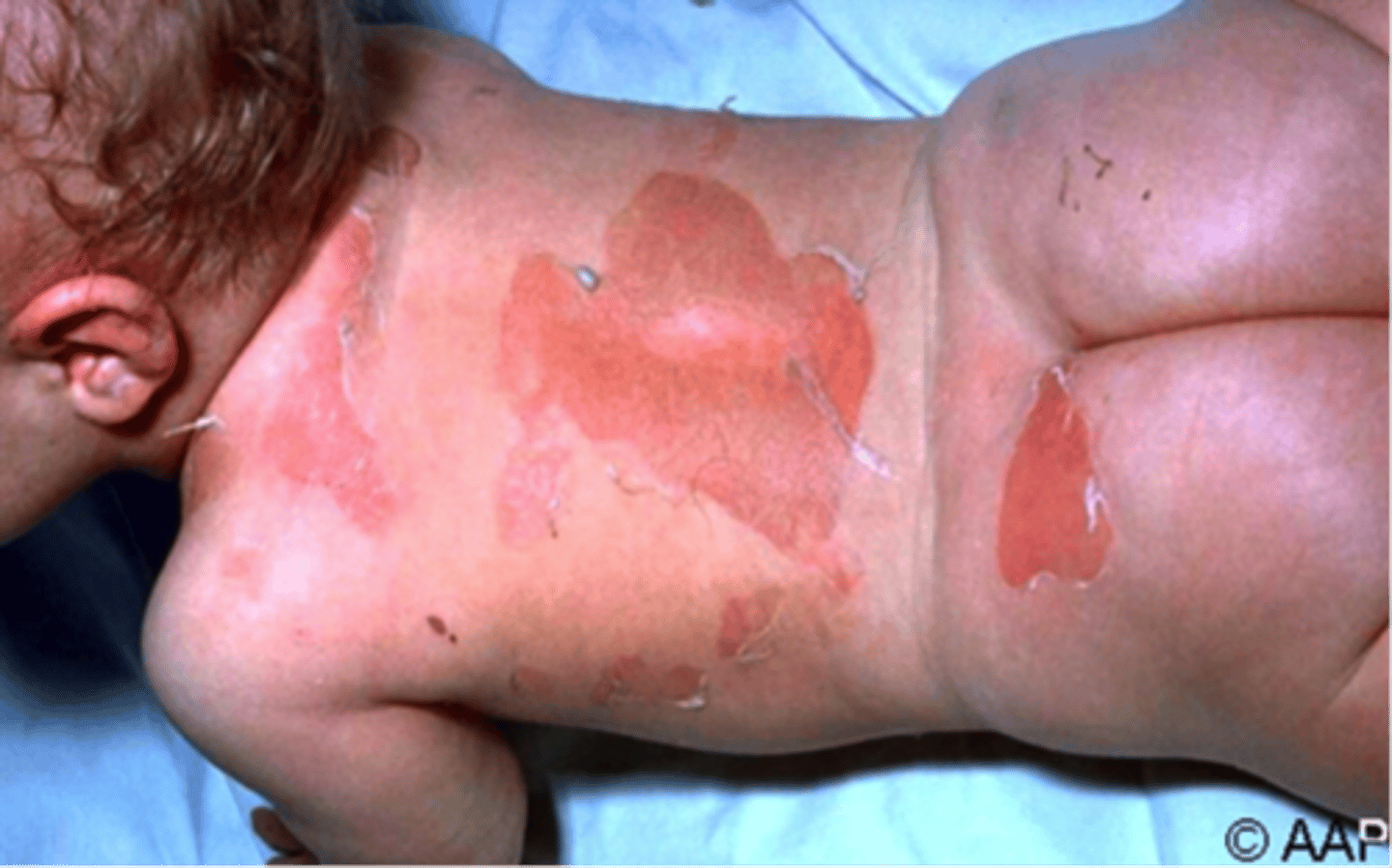 <p>PE:</p><p>Ill-defined erythema w/ fine, sandpaper appearance</p><p>24h later, deeper erythema and painful skin</p><p>Superficial sloughing begins</p><p>Skin appears wrinkled and can be removed w/ gentle pressure</p>