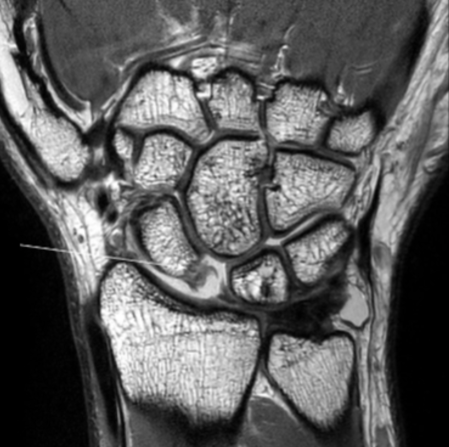 <p>Describe the pathology indicated by the arrow (Cor PD). </p>