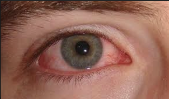 <p>what is conjunctivitis a symptom of?</p>