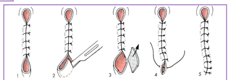 <ul><li><p>puckers of skin at the end of the incision line </p></li><li><p>correction via various methods </p><ul><li><p>outline with an elliptical incision, remove redundant skin, appose skin edges </p></li><li><p>cut off the dog ear - blade or scissors </p></li></ul></li></ul><p></p>