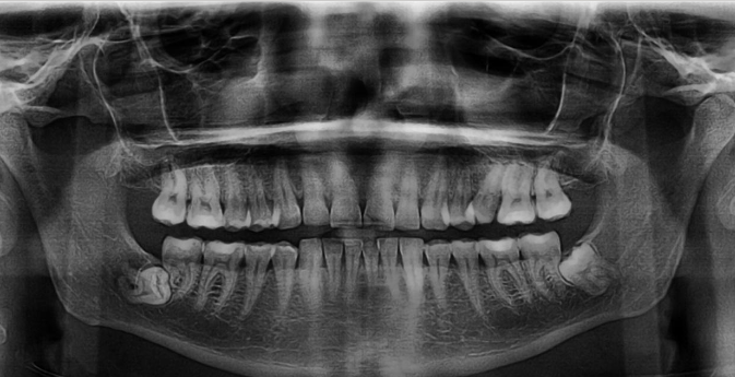 <ul><li><p class=""><strong>Impaction</strong>: Tooth is obstructed by a physical barrier.</p></li><li><p class=""><strong>Embedded</strong>: Tooth lacks eruptive force to emerge.</p></li><li><p class=""><strong>Rarely occurs in deciduous teeth</strong></p></li></ul><p></p>