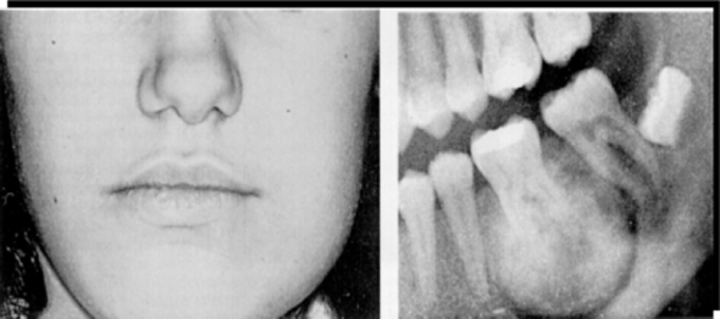 <p>Young adult male patient presents to your office with pain and swelling. Radiograph shows a a radiopaque bulbous lesion that is attached to the root of the mandibular 1st molar (# 19), with a radiolucent corticated halo that is continuous with the PDL space of the root. Some root resorption is noted. The tooth is still vital. What is the diagnosis?</p>