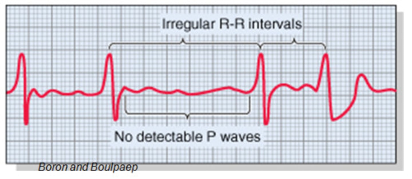 <p>"The irregularity is normal and is a result of respiration."</p><p>( irregular R-R intervals are commonly seen on pediatric EKGs)</p>